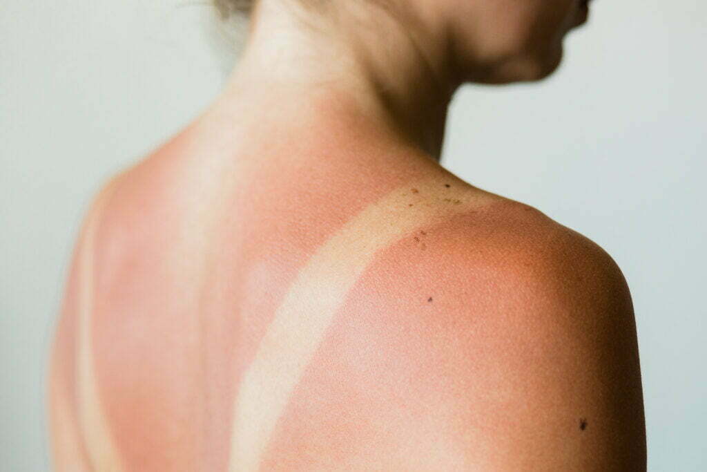 red skin due to sunburn