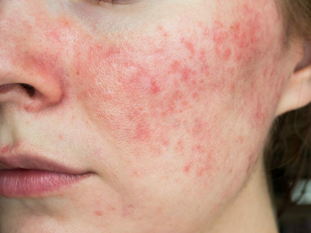 red skin due to rosacea